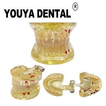 Модель зубов Съемная модель патологии с половинной стороны для практики студентов-стоматологов, обучающих Обучающие модели